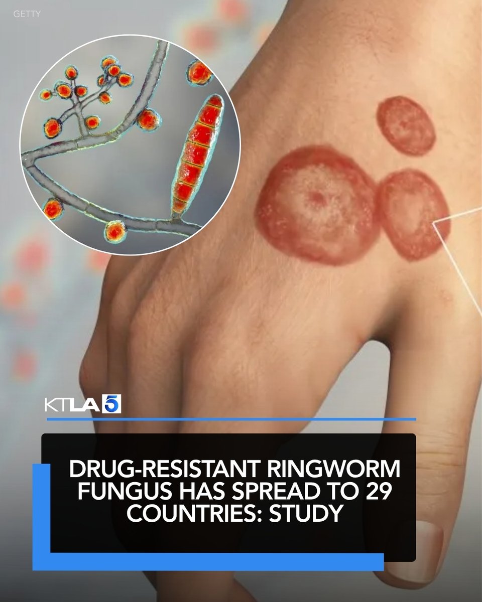KTLA's tweet photo. A skin fungus that causes ringworm and does not respond to standard treatment is spreading to more countries each year, according to a new CDC study. https://t.co/B6usB2Kr0E https://t.co/tmxB7WGQV1