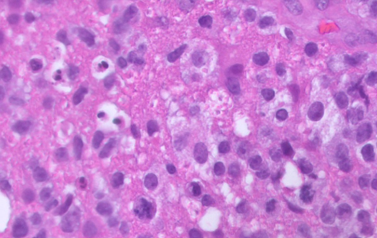 PeterKobalka's tweet photo. 65m frontal lobe mass. What’s your diagnosis (see poll below)
#Neuropath #Neuropathology
#CNSpathology #Pathtwitter #Pathx https://t.co/yFpl9OGUoR