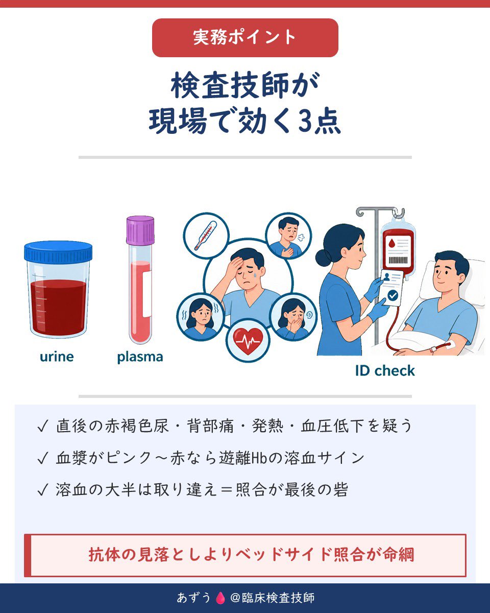 az_mt111's tweet photo. 【補体が起こす「血管内溶血」🩸】

同じ「溶血」でも、赤血球が壊れる場所は同じではありません。

補体がC1→C4→C2→C3…と活性化し、最終的にMAC（C5b-9）まで完成すると、赤血球膜に穴が開きます。

そこから水が流れ込み、赤血球が血管内で破裂。
これが「血管内溶血」です。

🔍 血管内溶血を疑うデータ
・血漿が赤い（遊離Hb↑）
・赤褐色のヘモグロビン尿
・ハプトグロビン著明低下
・LD、間接ビリルビン上昇

特に怖いのが「ABO不適合輸血」⚠️

抗A・抗BはIgM型の自然抗体で、強力に補体を活性化します。

そのため急激な血管内溶血を起こし、血圧低下→急性腎障害→DICへ進むことも。

そして輸血で重要なのは、抗体を見つけることだけではありません。

患者・検体・製剤を「取り違えない」こと。

ベッドサイドでの照合は、重大な輸血事故を防ぐ最後の砦です🩸