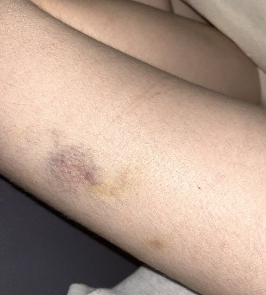 Fukase40194's tweet photo. aren’t I just such a messy boy hit me harder next time #bruise #sh #beating #angerissues https://t.co/efeN8GPx4U