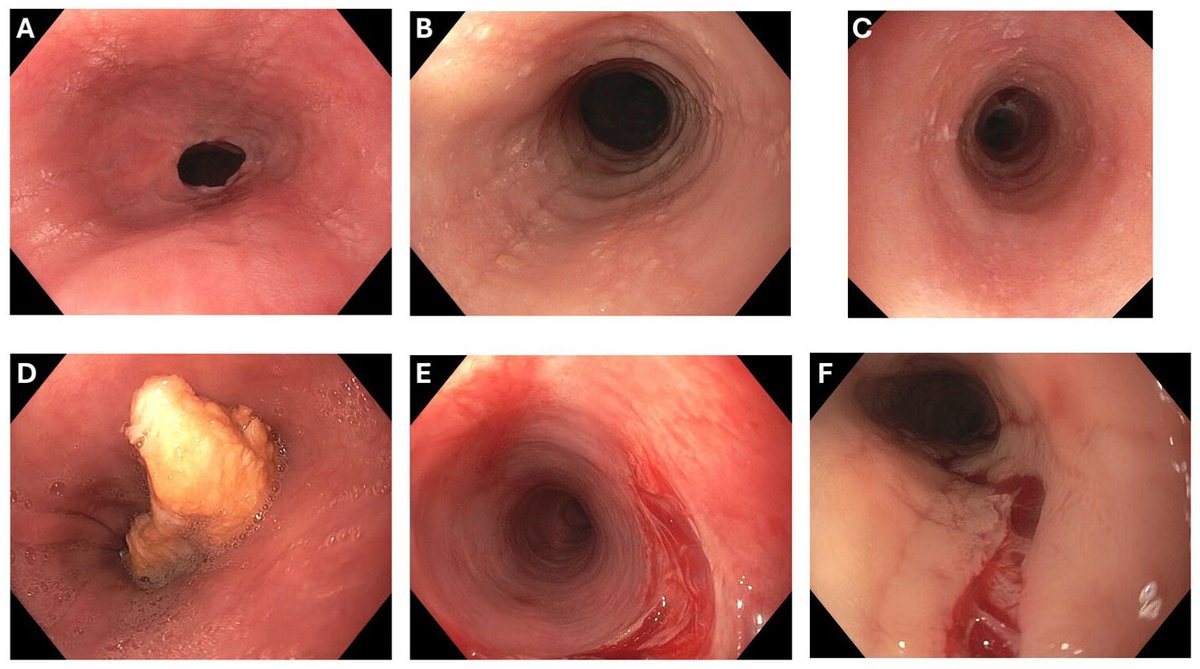 foregut_journal's tweet photo. 🆕📘 New in Foregut

🔬 Eosinophilic esophagitis: complications that matter
⚠️ Fibrostenosis &amp; strictures
🥩 Food impaction
🩺 Dilation &amp; perforation
🛡️ Prevention through early diagnosis and treatment

🔗 https://t.co/rszdLg4qyT

#Foregut #EoE https://t.co/wy2tK86RuN