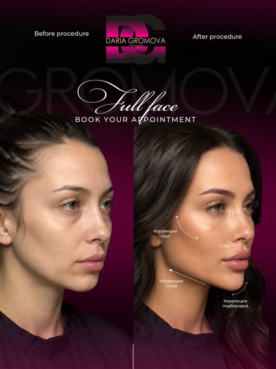 kaan_ferdi's tweet photo. Full Face: MXN 10, 500. I’ll be working in Cancún on August 8, 9, and 10. I won’t be back for another 3–4 months after that. 5 ml + Botox = Goodbye tired-looking face

The Full Face combo restores lost volume naturally—not an overdone look. Cheek https://t.co/1kiuCBPNTc