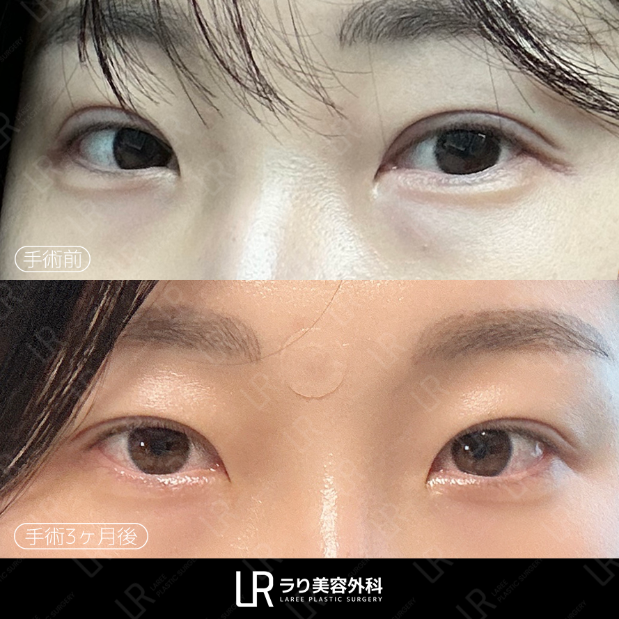 lareeclinic's tweet photo. 二重ラインの固定が深すぎたり、
厚すぎると感じたことはありませんか？

✔️ ソーセージのようにぷっくりした二重
✔️ 二重の深い固定
✔️ 自分に合わないデザイン

わずか1～2mm程度ラインを下げるだけでも、印象が変わります。

#二重整形再手術 https://t.co/olQhz2QXgU