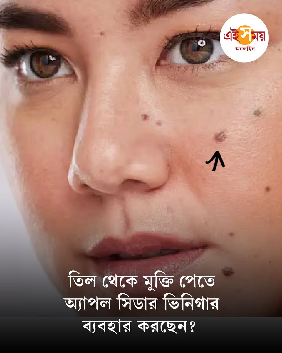 Ei_Samay's tweet photo. ত্বকের তিল অনেকের কাছেই অস্বস্তির কারণ হতে পারে। তাই তিল দূর করার সহজ ঘরোয়া উপায় হিসেবে ইন্টারনেটে বহু পন্থার হদিশ পাওয়া যায়...
বিস্তারিত: https://t.co/pIP6BMa6NJ
#MoleRemoval #SkinMole #AppleCiderVinegar #SkinCare #EiSamay https://t.co/05Tkla1DKw