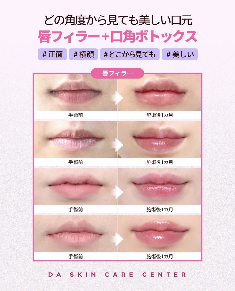 da_skin_jp's tweet photo. DA唇フィラー💋💕
自然なラインとボリューム感を出すなら
✨ジュビダーム唇フィラー&口角ボトックス✨
正面・横顔・どの角度から見ても綺麗な唇にしませんか？🫶🏻

是非DAプチセンターでお試しください❣️
DA プチセンター公式ラインからご予約いただけます🤍

♥お問い合わせは♥
💚LINE : https://t.co/6saMUjv6IR