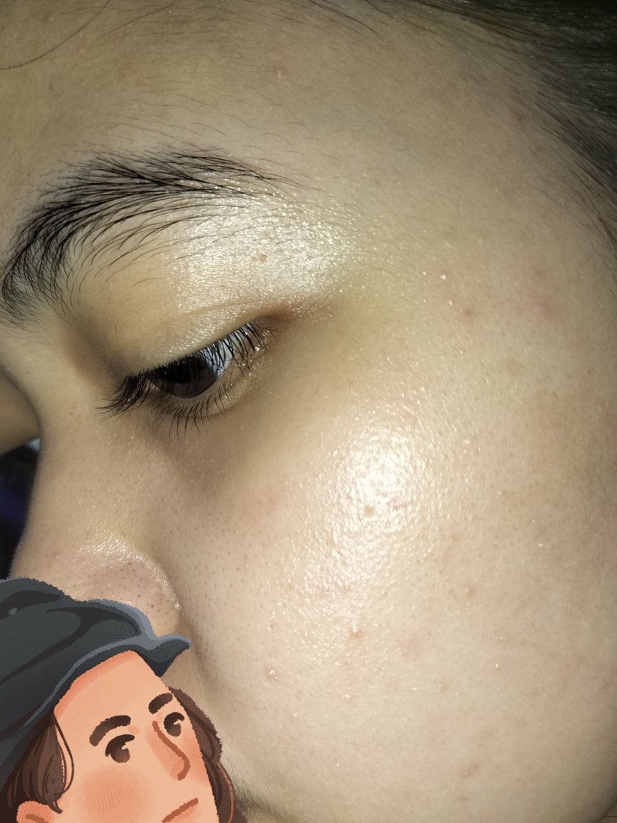 urpiws's tweet photo. saran skincare dong guys untuk aku, tbtb sekarang ada beruntusan kaya gitu huhu,    sekarang aku pakai moist skin1004 putih tp ky ga ngaruh apa apa😔 help https://t.co/raJGVCmg0Q