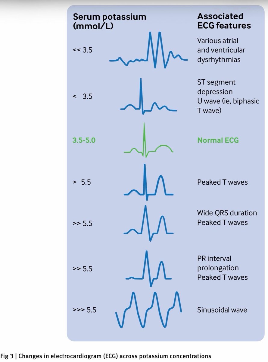 MarlonVFZR's tweet photo. ⚡🫀𝗛𝗜𝗣𝗘𝗥𝗞𝗔𝗟𝗘𝗠𝗜𝗔 𝗔𝗚𝗨𝗗𝗔‼️
@bmj_latest
👇🏼👇🏼👇🏼👇🏼
📑🔗🔑🔓
https://t.co/89ht2mBRSA
⬇️⬇️⬇️⬇️
🧵👇

🚨 Alto riesgo: 𝙆⁺ >𝟲,𝟱 𝙢𝙢𝙤𝙡/𝙇, cambios ECG, aumento rápido, debilidad/parálisis o inestabilidad.

Pero:

❌ ondas T picudas tienen baja sensibilidad
❌ el ECG no se correlaciona bien con el nivel de K⁺
❌ no espere cambios clásicos para iniciar tratamiento

🔥 El riesgo es un 𝙘𝙤𝙣𝙩𝙞𝙣𝙪𝙤, no un número aislado.

🩺⚡ 𝙋𝙖𝙨𝙤 𝟭: 𝘾𝘼𝙇𝘾𝙄𝙊 — 𝙥𝙧𝙤𝙩𝙚𝙜𝙚 𝙚𝙡 𝙘𝙤𝙧𝙖𝙯𝙤́𝙣, 𝙥𝙚𝙧𝙤 𝙉𝙊 𝙗𝙖𝙟𝙖 𝙚𝙡 𝙥𝙤𝙩𝙖𝙨𝙞𝙤

Si hay alteraciones ECG:

💉 𝙜𝙡𝙪𝙘𝙤𝙣𝙖𝙩𝙤 𝙙𝙚 𝙘𝙖𝙡𝙘𝙞𝙤 𝙄𝙑
🫀 𝙘𝙡𝙤𝙧𝙪𝙧𝙤 𝙙𝙚 𝙘𝙖𝙡𝙘𝙞𝙤 preferido en paro cardíaco o vía central

⏱️ Inicio ≈ 𝟯 𝙢𝙞𝙣
⏳ duración: 𝟯𝟬–𝟲𝟬 𝙢𝙞𝙣

➡️ Repetir si el ECG no mejora.

🔥 El calcio restaura la conducción cardíaca; inmediatamente después hay que 𝙢𝙤𝙫𝙚𝙧 𝙮 𝙚𝙡𝙞𝙢𝙞𝙣𝙖𝙧 𝙆⁺.

💉🍬 𝙋𝙖𝙨𝙤 𝟮: 𝙢𝙤𝙫𝙚𝙧 𝙆⁺ 𝙖𝙡 𝙞𝙣𝙩𝙚𝙧𝙞𝙤𝙧 𝙘𝙚𝙡𝙪𝙡𝙖𝙧

🥇 𝙄𝙣𝙨𝙪𝙡𝙞𝙣𝙖 𝙧𝙚𝙜𝙪𝙡𝙖𝙧 𝟱–𝟭𝟬 𝙐 𝙄𝙑
➕ 𝙙𝙚𝙭𝙩𝙧𝙤𝙨𝙖 𝟮𝟱–𝟱𝟬 𝙜

📉 reducción esperada: 𝟬,𝟲–𝟭,𝟰 𝙢𝙢𝙤𝙡/𝙇
⚡ inicio: <15 min

Pero:

⚠️ hipoglucemia ocurre en ≈𝟭𝟳%
📊 monitorizar glucosa cada 30–60 min durante ≥4 h

En ERC, AKI, bajo peso, insulin-naive o glucemia <126 mg/dL:

👉 𝟱 𝙐 puede reducir hipoglucemia sin perder eficacia.

🌬️🧪 𝙎𝙖𝙡𝙗𝙪𝙩𝙖𝙢𝙤𝙡 𝙨𝙪𝙢𝙖; 𝙗𝙞𝙘𝙖𝙧𝙗𝙤𝙣𝙖𝙩𝙤 𝙉𝙊 𝙚𝙨 𝙩𝙧𝙖𝙩𝙖𝙢𝙞𝙚𝙣𝙩𝙤 𝙧𝙪𝙩𝙞𝙣𝙖𝙧𝙞𝙤

🌬️ 𝙎𝙖𝙡𝙗𝙪𝙩𝙖𝙢𝙤𝙡 𝟭𝟬–𝟮𝟬 𝙢𝙜 𝙣𝙚𝙗𝙪𝙡𝙞𝙯𝙖𝙙𝙤
→ reduce K⁺ ≈𝟬,𝟲𝟱–𝟭 𝙢𝙢𝙤𝙡/𝙇

Combinado con insulina puede lograr un efecto mayor.

🧪 𝘽𝙞𝙘𝙖𝙧𝙗𝙤𝙣𝙖𝙩𝙤: efecto pequeño e inconsistente.

🚫 No usar rutinariamente para hiperpotasemia aguda.
✅ Considerarlo solo en pacientes seleccionados con 𝙖𝙘𝙞𝙙𝙤𝙨𝙞𝙨 𝙢𝙚𝙩𝙖𝙗𝙤́𝙡𝙞𝙘𝙖 𝙨𝙞𝙜𝙣𝙞𝙛𝙞𝙘𝙖𝙩𝙞𝙫𝙖 y tolerancia a la carga de sodio.

🔥 Corregir la acidosis no equivale necesariamente a corregir la hiperpotasemia.

🎯 𝙋𝙖𝙨𝙤 𝟯: 𝙚𝙡 𝙥𝙤𝙩𝙖𝙨𝙞𝙤 𝙙𝙚𝙗𝙚 𝙎𝘼𝙇𝙄𝙍 𝙙𝙚𝙡 𝙘𝙪𝙚𝙧𝙥𝙤

💧 Diuréticos de asa → solo si existe 𝙨𝙤𝙗𝙧𝙚𝙘𝙖𝙧𝙜𝙖 𝙙𝙚 𝙫𝙤𝙡𝙪𝙢𝙚𝙣 + 𝙛𝙪𝙣𝙘𝙞𝙤́𝙣 𝙧𝙚𝙣𝙖𝙡 𝙪́𝙩𝙞𝙡

🧲 Quelantes:

* 𝙎𝙕𝘾: inicio ≈1 h
* 𝙋𝙖𝙩𝙞𝙧𝙤𝙢𝙚𝙧: 2–7 h
* SPS: evidencia limitada y riesgo gastrointestinal

⚠️ Ninguno sustituye la terapia definitiva en hiperpotasemia grave.

🩸 𝙃𝙚𝙢𝙤𝙙𝙞𝙖́𝙡𝙞𝙨𝙞𝙨 = 𝙢𝙚́𝙩𝙤𝙙𝙤 𝙢𝙖́𝙨 𝙚𝙛𝙞𝙘𝙖𝙯
📉 ≈1 mmol/L en la primera hora
📉 hasta ≈2 mmol/L en 3 h

Indicaciones especialmente importantes:

🚨 hiperpotasemia refractaria
🫘 AKI grave/oliguria
🩸 enfermedad renal terminal
⚡ alteraciones ECG persistentes

📌𝙂𝙪𝙖𝙧𝙙𝙖 𝙥𝙖𝙧𝙖 𝙩𝙪 𝙥𝙧𝙤́𝙭𝙞𝙢𝙖 𝙜𝙪𝙖𝙧𝙙𝙞𝙖❤️

📚📖 Más en 𝕏 @MarlonVFZR y en el blog 👉 [https://t.co/i9GkW3SQFI]

‼️Si te sirve: ❤️ Me gusta | 🔁 Repost | ➕ Follow para más👇🏼👇🏼👇🏼👇🏼
📚📖#ClubCrit👨🏻‍⚕️👨🏻‍🏫🧠🫶

#Hiperpotasemia #Hyperkalemia

#FOAMed #FOAMcc #CriticalCare #CriticalCare #CuidadoCritico #MedTwitter #MedX #IntensiveCare #MedXCommunity #MedED