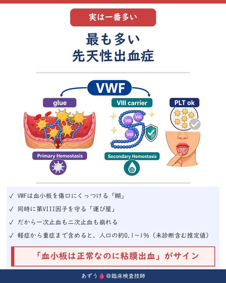 az_mt111's tweet photo. フォン・ヴィレブランド病（VWD）って？🩸

実はVWDは、先天性出血症の中で最も多い疾患です。

ポイントは「VWF」の2つの役割👇

① 血小板を傷口にくっつける“糊”
② 第VIII因子を守る“運び屋”

そのためVWFに異常があると、一次止血だけでなく二次止血にも影響します。

病型は大きく3つ👇
🔹1型：VWFの「量」が少ない
🔹2型：VWFの「質」が悪い
🔹3型：VWFがほぼ完全に欠損

検査では
✅ 血小板数：正常
✅ PT：正常
✅ APTT：正常〜軽度延長
が典型的。

ここで大事なのが、
「APTTが正常だからVWDではない」とは言えないこと⚠️

さらにVWF:Agで「量」、VWF:RCoで「働き」を評価し、RCo/Ag比から1型と2型を切り分けます🔬

そして覚えておきたい落とし穴👇
・2N型は血友病Aに似る
・2B型はDDAVPに注意
・ストレス、炎症、妊娠、運動などでVWFは上昇する

「血小板は正常なのに粘膜出血」🩸

この組み合わせを見たら、VWDを思い出したいところです。