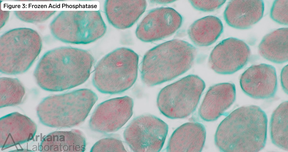 arkanalabs's tweet photo. Clinical History:

The patient is a young child a year prior to the current biopsy to have compound heterozygous GAA variants. Hex4 levels were initially elevated but since initiating enzyme replacement therapy, the levels have dropped within normal limits.

What enzyme is deficient in this patient’s disease?

A. Acid alpha-glucosidase
B. Glycogen phosphorylase
C. Glucose-6-phosphate translocase
D. Myophosphorylase

#NeuroNotes #neuropath #pathology #neuromuscularpath #PathX #PathTwitter