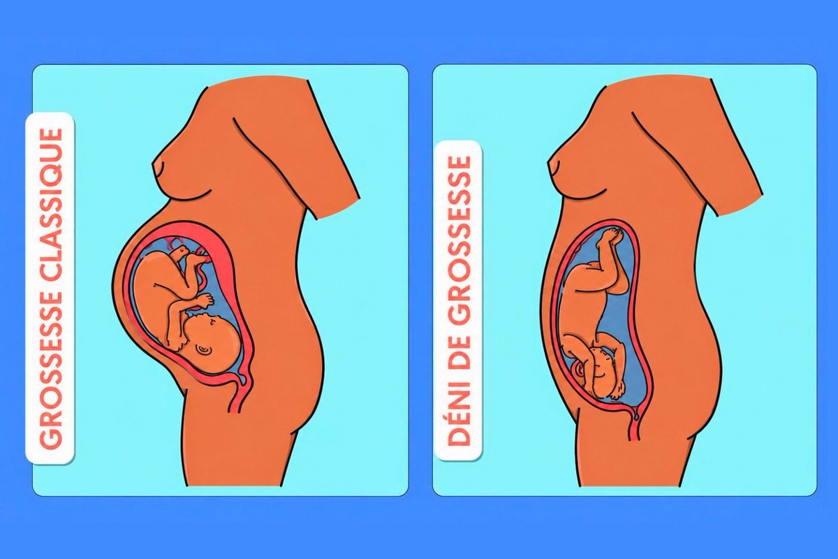 FalloppioGyn's tweet photo. À quel âge avez-vous appris que dans le déni de grossesse, l’utérus se déploie souvent en hauteur, le fœtus allongé ou recroquevillé en arrière / sous les côtes, d’où un ventre qui reste plat ? https://t.co/jGeSdVNV97