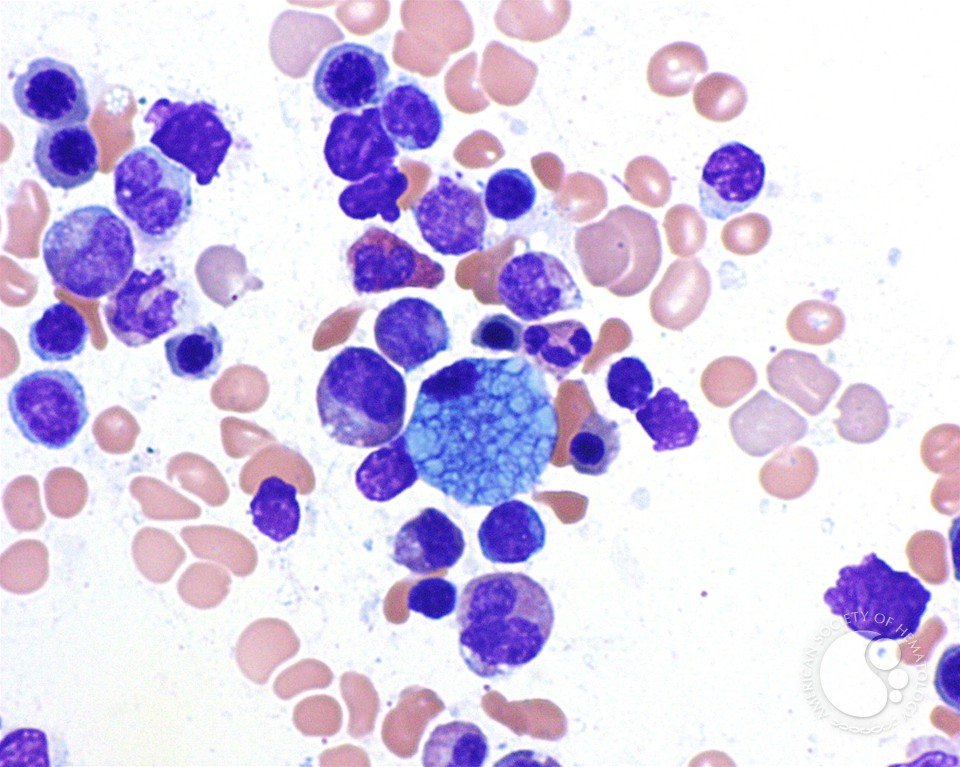 smbenlazar's tweet photo. Sea blue histiocyte | ASH Image Bank | American Society of Hematology https://t.co/S8USZhfVX2 #ASHImageBank https://t.co/yyb2Fqkh4e