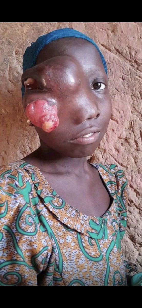 Comrdebarde's tweet photo. @daily_trust URGENT URGENT URGENT !!!!

FUNDRAISER FOR, RAMATU GARBA
( RHINOTOMY + CRANIOTOMY)

TARGET: N2.5million
RAISED: N500,000
Donation: Update
BALANCE: N2million

0017915318
Suleiman Abubakar 
Stanbic bank
08067444313

Please share &amp; retweet ✍️ https://t.co/J7EKmFXhaS