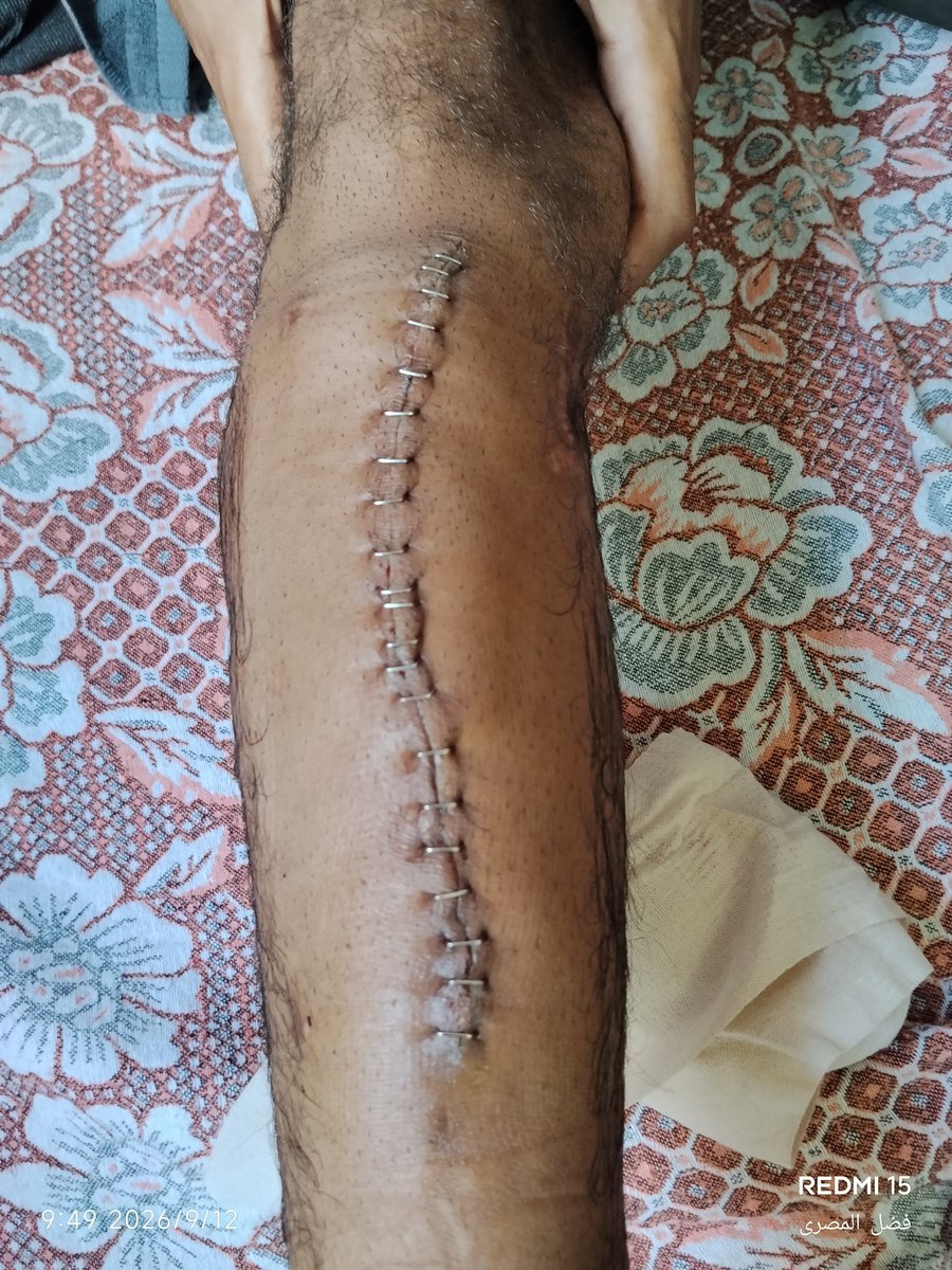 SAlmsry38871's tweet photo. I am Sanad from Gaza; I am enduring the pain of my injury and the suffering of my children, yet I cannot help them as I wish.
I need a fourth surgery, but I cannot afford the cost.
I appeal to kind-hearted people to help me and share my post—every bit of support matters. 🤲🤲💔 https://t.co/B7HI4jy5fm