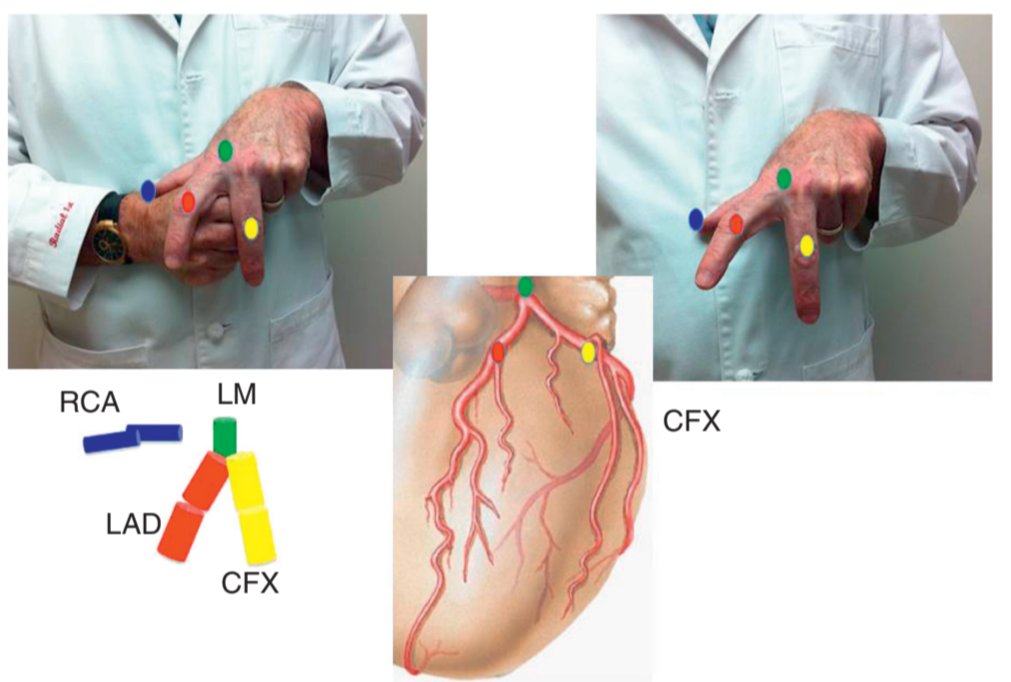 TrackYourHeart's tweet photo. LEARN THE CORONARY ARTERIES WITH YOUR HAND

A simple fist and fingers model can make coronary anatomy much easier to remember.

Think of the closed fist as the heart:

🟥 LAD: index finger, running down the anterior interventricular groove
🟨 LCx: middle finger, wrapping around the left side in the AV groove
🟦 RCA: thumb, beginning superiorly and continuing in the AV groove
🟩 LM: short segment before dividing into the LAD and LCx

The PDA arises distally and runs in the posterior interventricular groove. Its origin depends on coronary dominance.

This simple 3D mental model helps connect coronary anatomy with angiographic projections before you even enter the cath lab.

Reference: Kern M. Cath Lab Digest. 2011;19(8).