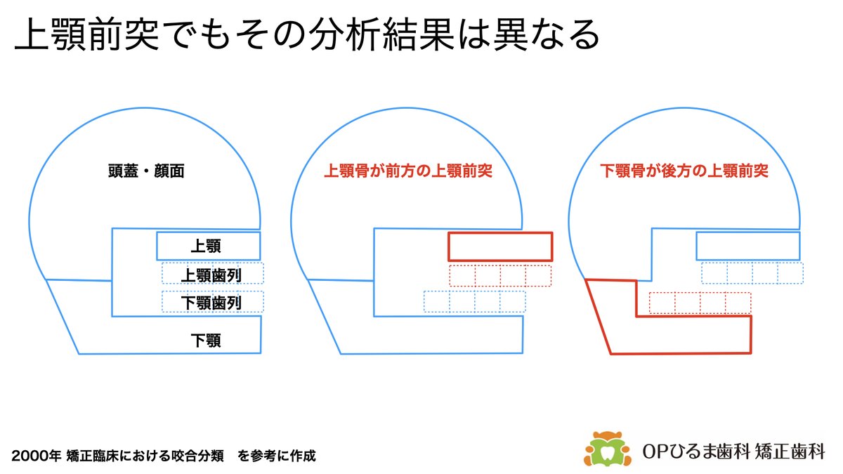 Yasu_OP's tweet photo. 矯正歯科医は不正咬合の原因をどんなふうに分析するの？

第1に骨格性，歯槽性の分析を行います

そのために，矯正歯科医は骨格と歯の部分を分けて分析しています

私は，図のようにイメージして分析しています

骨格の分析では，上顎骨が前方に突出しているのか，下顎骨が前方に突出しているのかなど頭蓋に対する上下顎骨の不調和，上下顎骨の相対的な位置関係を分析します

例えば上顎骨が前方に出ている場合は上顎前突と呼びますが，上顎が前方に出ているのか，下顎が後退しているのかを考えます（動画を参照）

歯槽性の分析では，顎の骨に対する歯の大きさや上下歯列の位置関係をを分析します

歯が大きぎて並び切らずに乱杭歯や八重歯（叢生）になっているのか

乱杭歯になりながら前方（唇側）に傾斜しているのか

顎の大きさに対して歯の大きさは適切なのに後方（舌側）に傾斜しているのか

などを考えます

この様な分析をして矯正歯科の診断につなげていきます

#矯正歯科　#歯列矯正