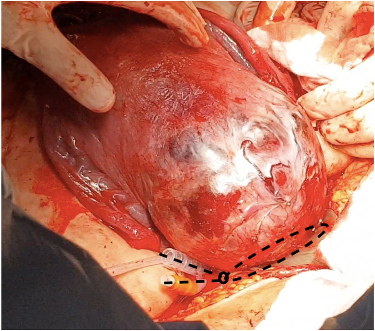 AJOG_thegray's tweet photo. Focal excision for placenta percreta based on pathoanatomy: the challenge of neovascularization - Temporary tourniquet hemostasis during focal resection of placenta percreta https://t.co/fRCjENB5ZY https://t.co/2blAta2XOV