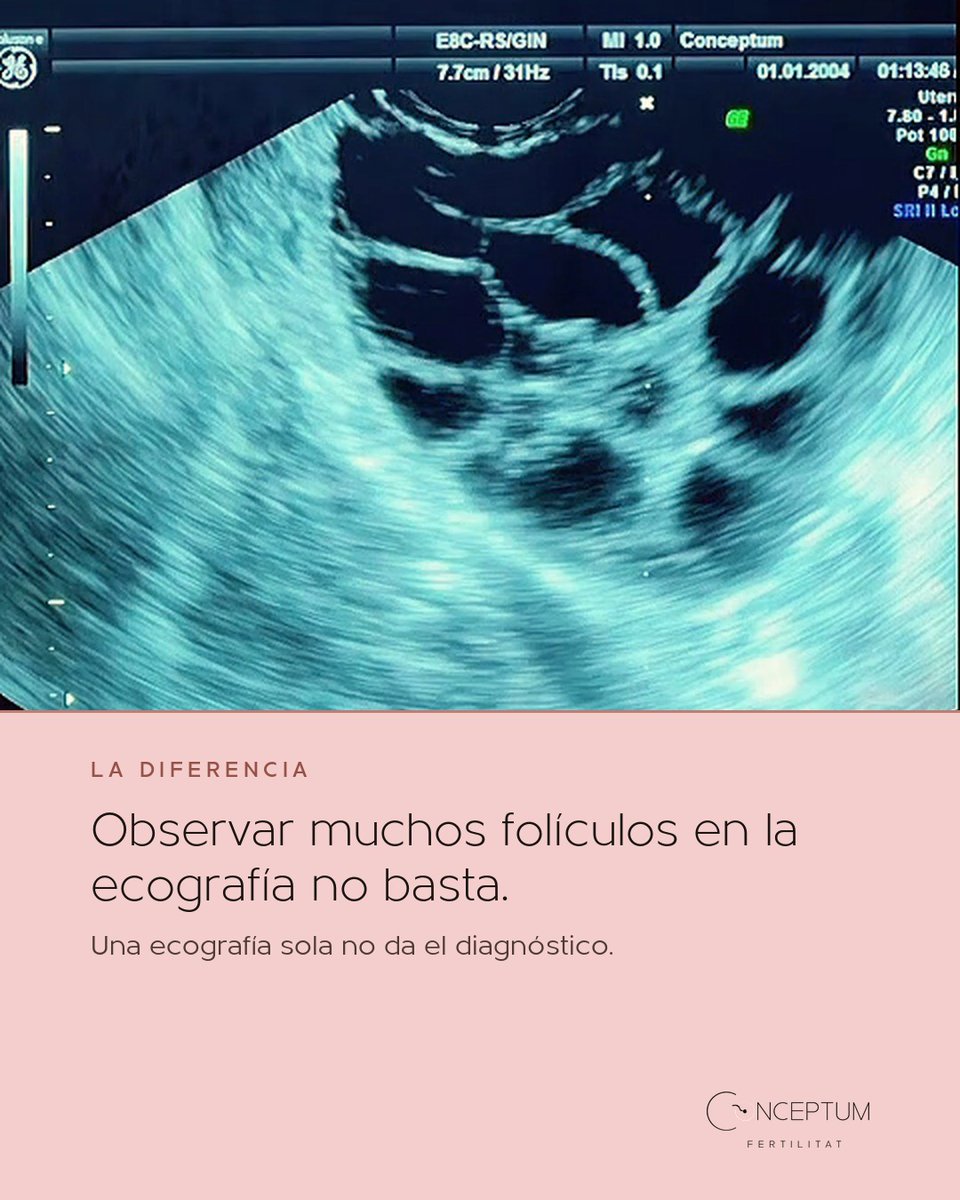IConceptum's tweet photo. Ovarios poliquísticos y síndrome de ovario poliquístico (la nueva nomenclatura: síndrome ovárico metabólico poliendocrino) no son lo mismo: observar muchos folículos en la ecografía no basta, hacen falt…

Pide tu primera visita en https://t.co/Z9jAwMkVen #Conceptum #Fertilidad https://t.co/RpKKhquwl2