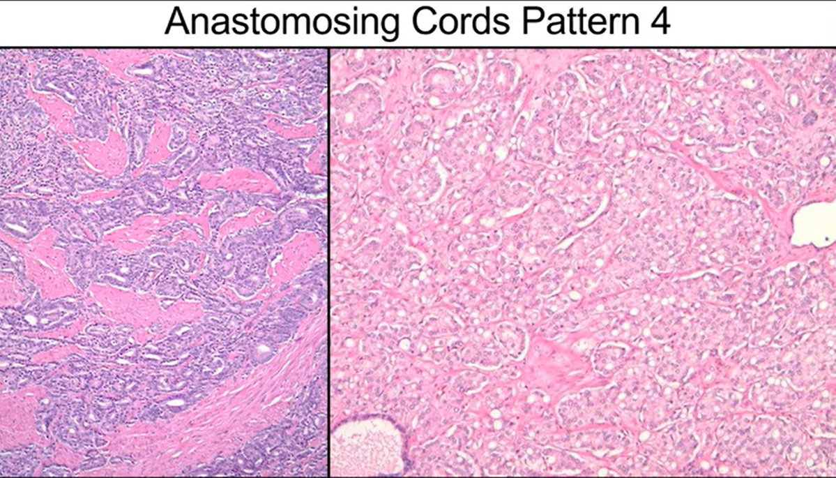 Janiranavarro's tweet photo. Gleason pattern 4- Anastomosing cords pattern

Represents the other 5-7% of prostate carcinomas associated with highly aggressive disease 

Dr. McKenney. Prostatic Adenocarcinoma Grading: 2026 Update #USCAP #pathology #PathX https://t.co/UG14dQcKpI