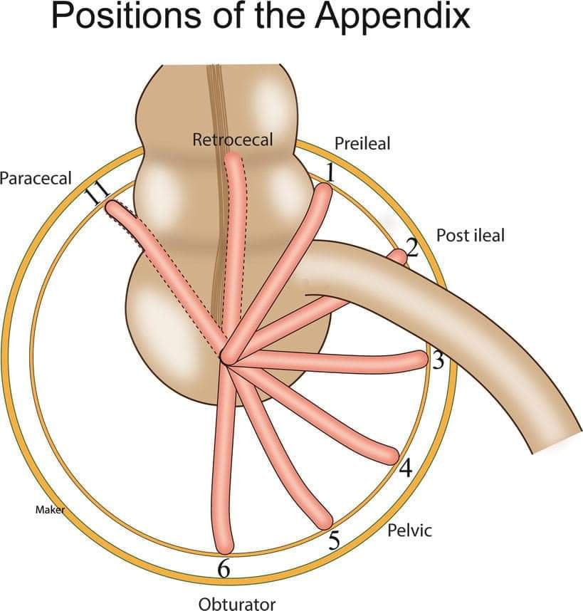 DrJStewart_GS's tweet photo. 1/5 🧭 Appendix position dictates clinical presentation. Atypical appendicitis is often just a typical appendix in an atypical position. Review of key anatomical variants.

#SoMe4Surgery #Anatomy #Surgery #MedEd https://t.co/L8ZkdkJn63