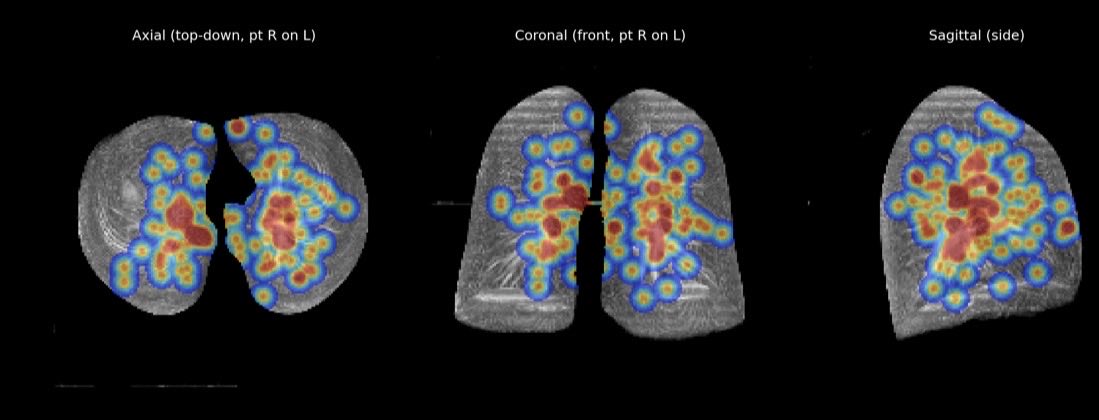 DrewMoghanaki's tweet photo. QUIZ: guess what treatment this picture represents. 

HINT: it’s from a scientific presentation at #ASTRO26 led by a #radonc team at UCLA with the largest experience in the world delivering this treatment. https://t.co/qzMbK7LaQK