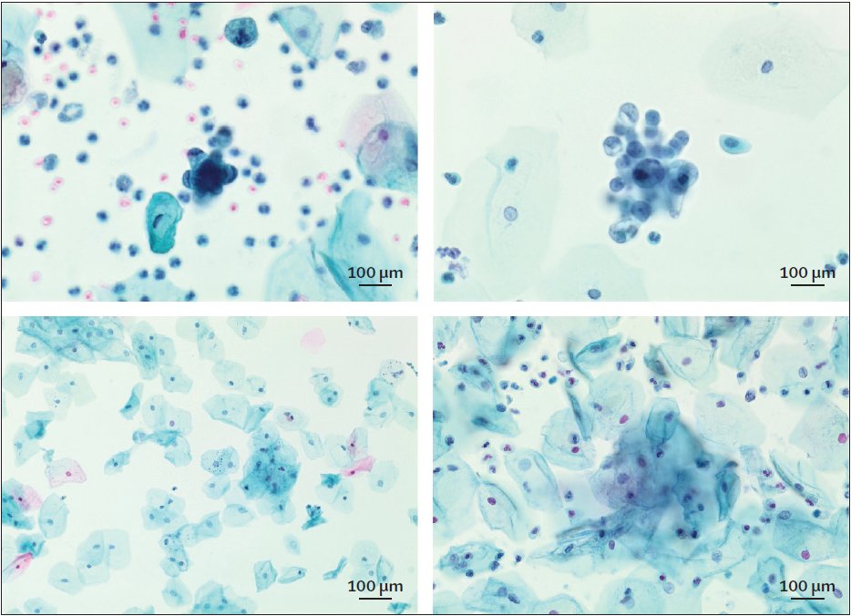 Vaginal and urine samples showing endometrial cancer (true positive case; upper row) and no malignant cells (true negative case; lower row). Top row: SurePath (CytoRich Red, Becton, Dickinson and Company, Franklin Lakes, NJ, USA) cytology slides (Papanicolaou stain): endometrial adenocarcinoma. Urine sample, \u00D7 600 magnification (left) and vaginal sample, \u00D7 600 magnification (right) from the study participant SMH0170 showing adenocarcinoma, clinical outcome grade 1 stage IB endometrioid adenocarcinoma, true positive. Bottom row: SurePath cytology slides (Papanicolaou stain): no malignant cells seen. Urine sample, \u00D7 400 magnification (left) and vaginal sample, \u00D7 600 magnification (right) from the study participant SMH0212 with no malignant cells seen, true negative. Copyright: 2026 The Author(s). Published by Elsevier Ltd. CC BY 4.0.