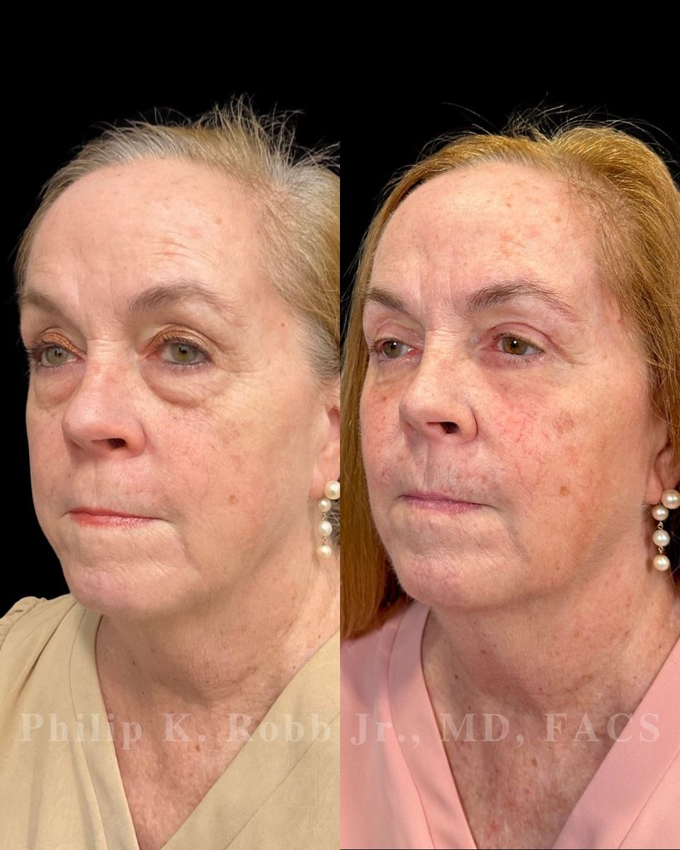 RobbJrMD's tweet photo. She tried everything for years. Nothing worked. 👀
Now Peggy is 1 month out from upper + lower bleph, buccal fat reduction, fat transfer & laser resurfacing — and finally addressing what had been bothering her for years. 🤩
#Blepharoplasty #FacialPlasticSurgery https://t.co/2DwFxKAtzS
