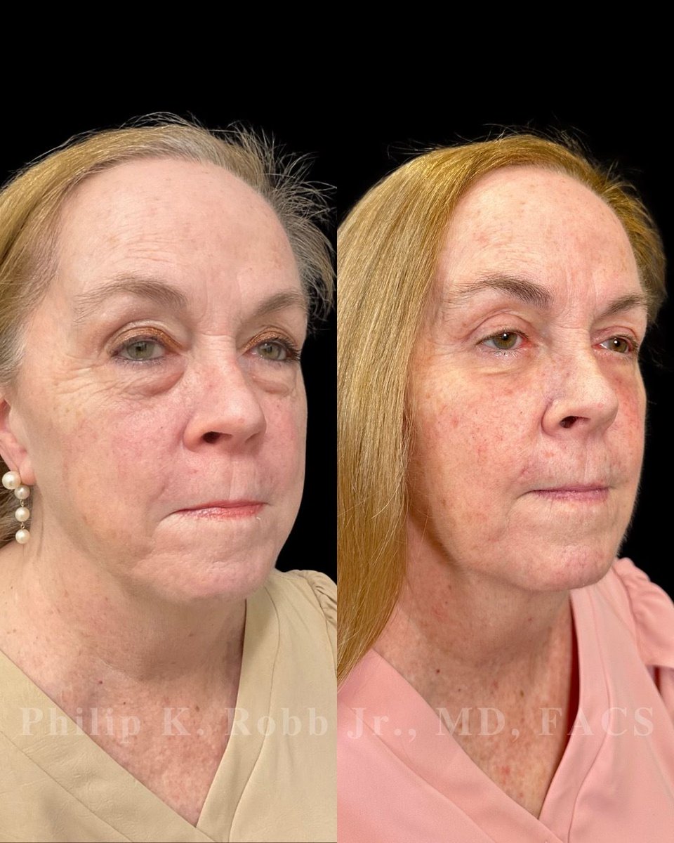 RobbJrMD's tweet photo. She tried everything for years. Nothing worked. 👀
Now Peggy is 1 month out from upper + lower bleph, buccal fat reduction, fat transfer & laser resurfacing — and finally addressing what had been bothering her for years. 🤩
#Blepharoplasty #FacialPlasticSurgery https://t.co/2DwFxKAtzS