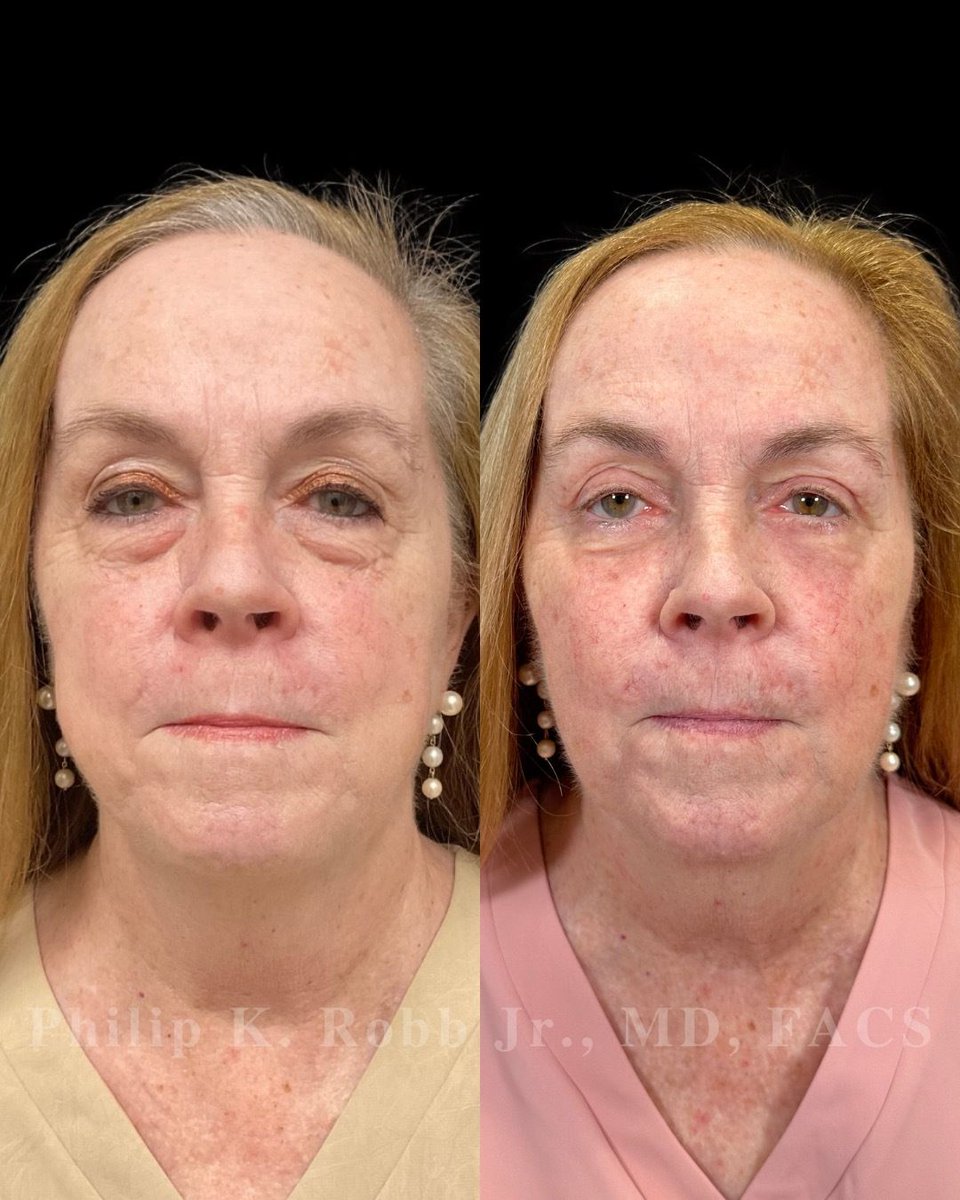 RobbJrMD's tweet photo. She tried everything for years. Nothing worked. 👀
Now Peggy is 1 month out from upper + lower bleph, buccal fat reduction, fat transfer & laser resurfacing — and finally addressing what had been bothering her for years. 🤩
#Blepharoplasty #FacialPlasticSurgery https://t.co/2DwFxKAtzS