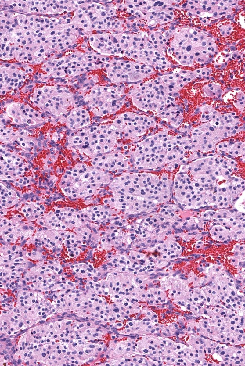 JMGardnerMD's tweet photo. Can you make the diagnosis from one pic, or is it #TooCloseToDiagnose?
Answer ✅ https://t.co/RyabuQuyID
Digital slide🔬https://t.co/w0SE6dGxPx  
What is this pattern called? ➡️ https://t.co/IaGtPQlJ1Q
#BSTpath #pathologists #pathology #pathTwitter https://t.co/isySsrlZ05