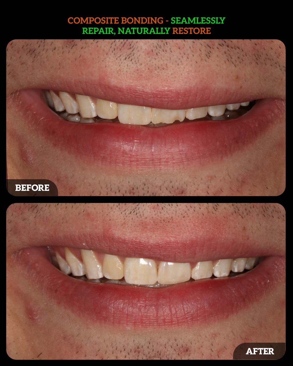 DMDGroup's tweet photo. Composite bonding offers a quick, effective, and natural-looking solution to restore the appearance of damaged teeth.
📞 (614) 766-5600
#CompositeBonding #DublinMetroDental #CosmeticDentistry #ChippedToothRepair #SmileMakeover https://t.co/os8Tg5Cx9o
