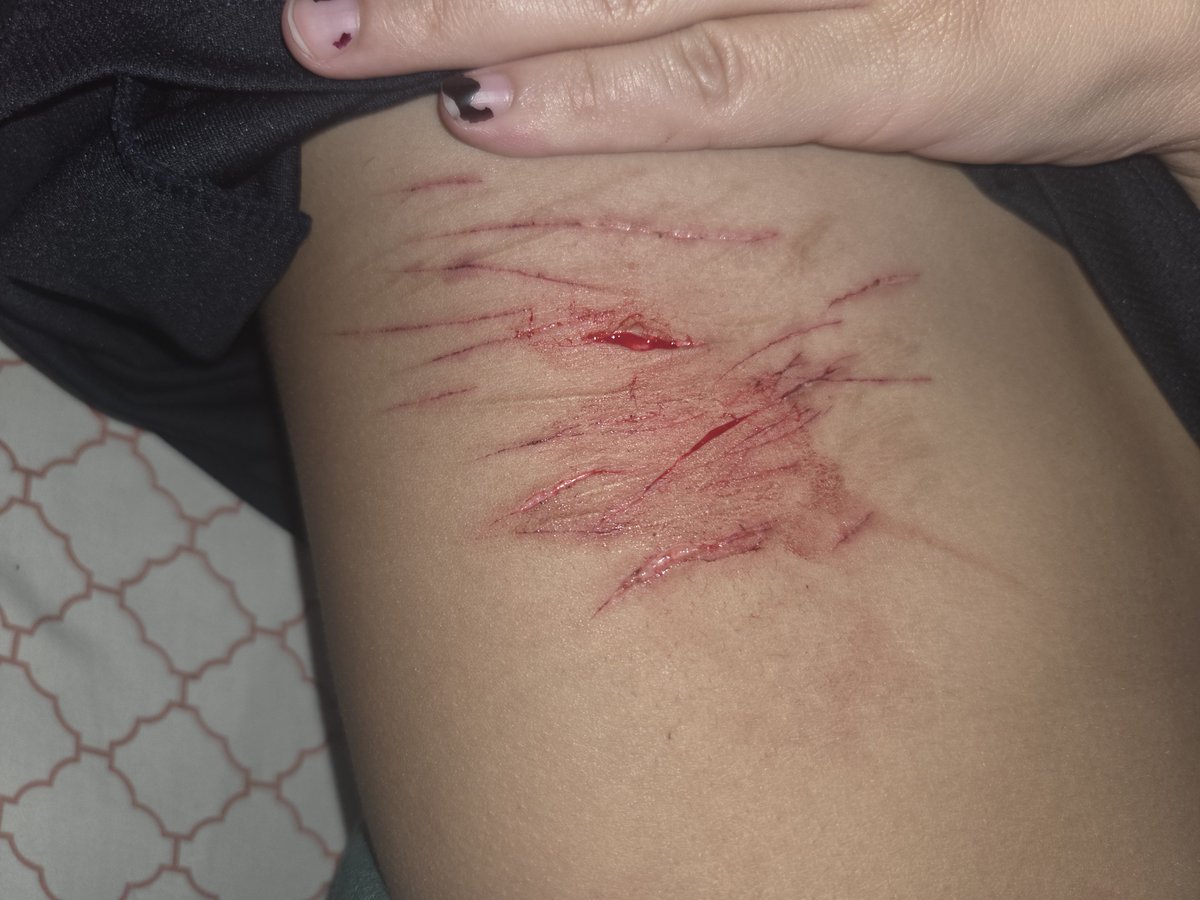 Iturnlevtnow's tweet photo. Practicing my sfx ☺️☺️☺️😋

Ribs and thighs ::)))
 Bad photos but wtv
#slittwt #shtwt #988twt 

ALL FAKE JUST MAKEUP FOR HALLOWEEN ELL OH ELL! https://t.co/9FS6RRudZV