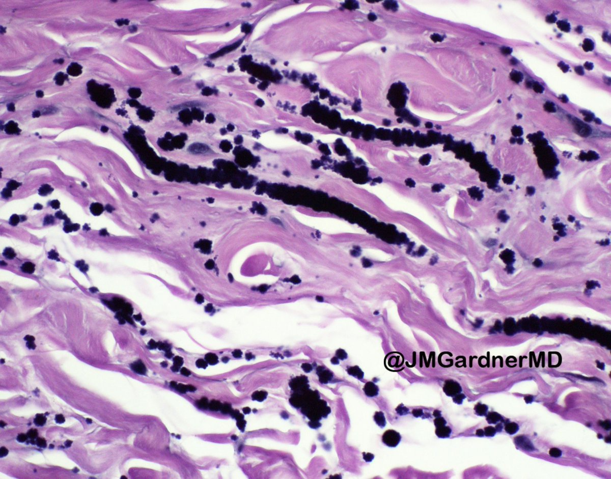 JMGardnerMD's tweet photo. CLASSIC image. VVG elastic stain. Diagnosis?
Answer ✅ https://t.co/XcNnrkm27J  
Hint: @Chucktowndoc loves seeing these (&amp; so do I!). 
#BSTpath #pathologists #pathology #pathTwitter https://t.co/yvKwo1wolN