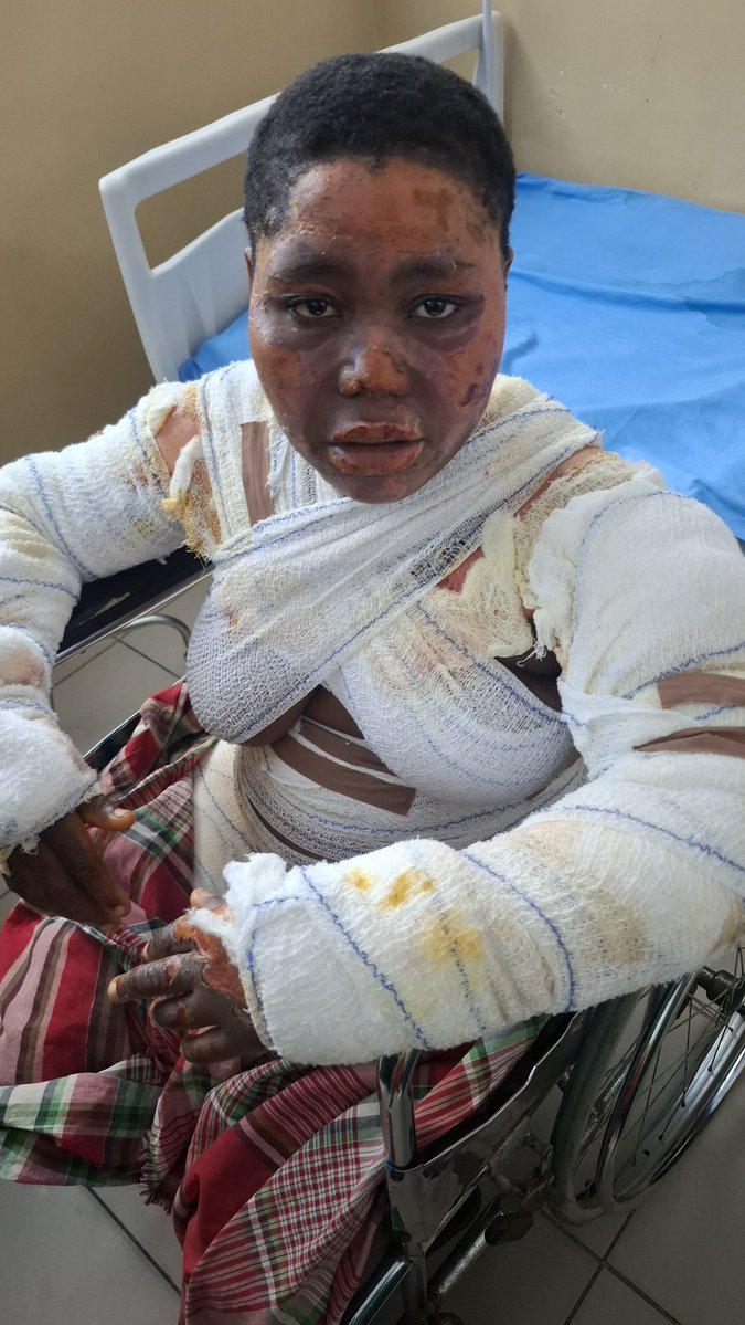 EcoHomef's tweet photo. Victims of Systemic Neglect

It is a devastating reality that the Bille fire victim, who survived the initial tragedy, has lost her life, not to the flames, but to the silence and neglect of a government and her health facility. 

This is not just a single failure, it is a recurring indictment of our healthcare system. How many more lives must be sacrificed to systemic apathy? 

Survivors of a catastrophe should be finding healing, not fighting for basic care in the very places meant to save them.

A stream of sympathies will flow, but we need more than just sympathy. We need accountability. We need systemic reform to ensure that every life, regardless of circumstances, is treated with dignity and urgency. 

Our thoughts are with the family and the community of the deceased. We must continue to demand better. Bille population must not be left to burn and die like her. 

Lovers of Rivers State, Nigeria’s Niger Delta Region and Environmental Justice must quickly take every lawful action to compel accountability!

@NnimmoB @CAPPAfrica @kebetkachewomen @ERAFoEN1 @SocialActionNg @centrelsd
@Radec46 @wtpnigeria

#HealthcareReform #Nigeria #BilleFire #JusticeForPatients #AccountabilityNow #HealthcareCrisis
