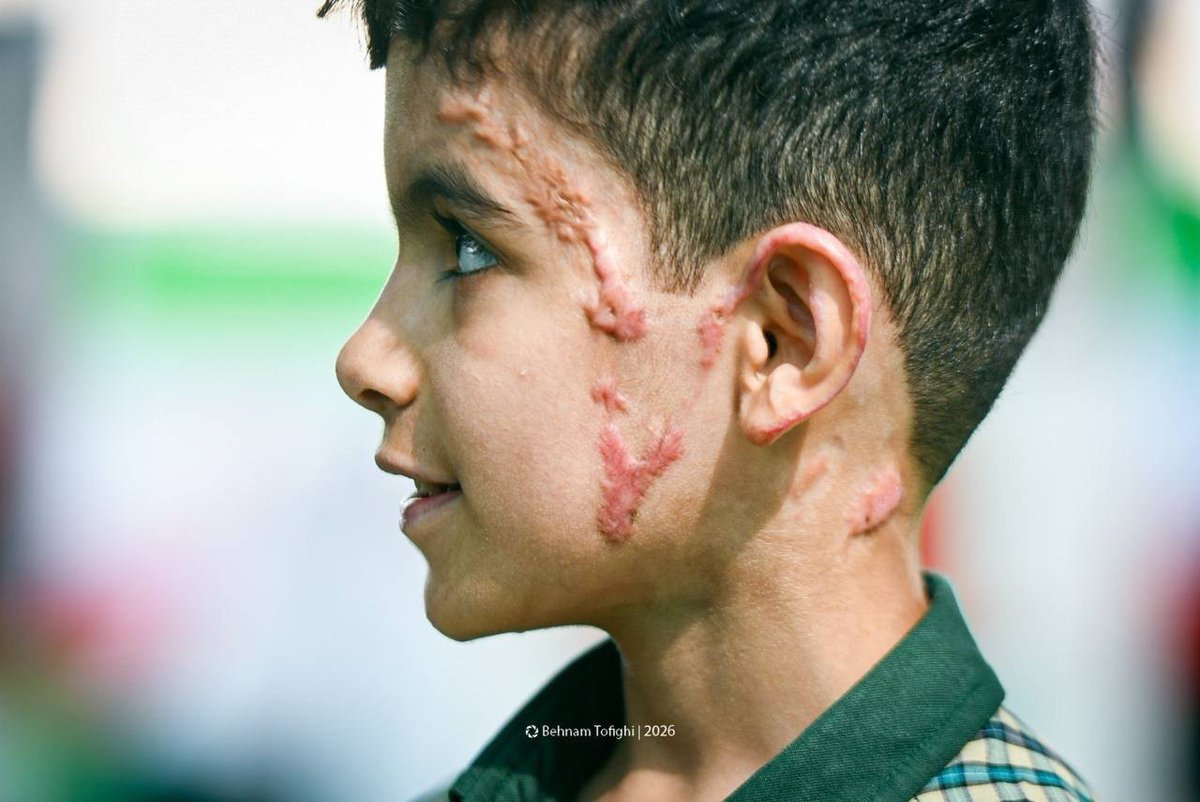 IranMilitaryEN's tweet photo. An image showing the effects of American bombing on the face of a student from Minab, Iran. https://t.co/fvm637qfJU