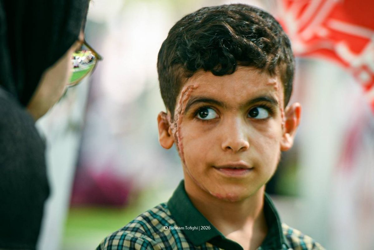 IranMilitaryEN's tweet photo. An image showing the effects of American bombing on the face of a student from Minab, Iran. https://t.co/fvm637qfJU