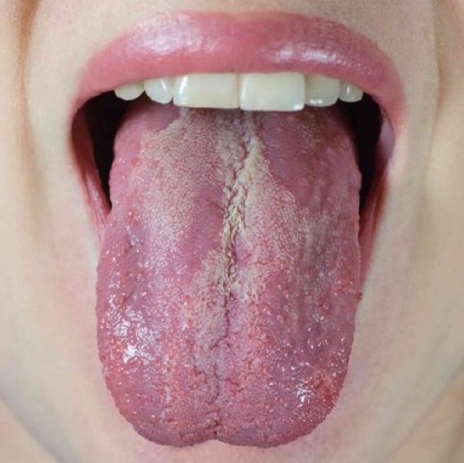 FarvingCo's tweet photo. Cranberry BLOCKED 80% of Candida biofilm formation IN JUST 24 HOURS - without a single antifungal drug.

If you have:

- white coating on your tongue
- brain fog after eating carbs
- bloating that gets worse with sugar
- recurring yeast infections
- fatigue no matter what you do

Candida might be hiding behind a biofilm nothing else can reach. Cranberry reaches it.

The mechanism: cranberry grabs the iron Candida needs to build the shield. No iron > no shield > no protection. When they added iron back, Candida survived. That's how they proved it.

The catch: cranberry juice is highly acidic. It kills oral Candida but the acid destroys your enamel if you leave it.

My technique: pure unsweetened cranberry juice (not cocktail - no sugar). Swish 30-60 seconds. Spit. Wait 30 seconds. Then 1/2 teaspoon baking soda in water, swish 30 seconds. Spit. Every morning before brushing.

The cranberry kills the Candida. The baking soda neutralizes the acid before it touches your enamel.

Try it for a week. Reply with what your tongue looks like after.

Study: (PMC3273432)