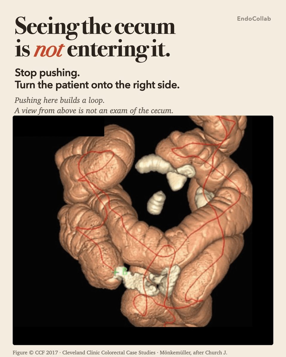 EndoCollabcom's tweet photo. You can see the cecum. The scope will not go in. Pushing only makes a loop.
 
Stop pushing. Turn the patient onto the right side. A view from above is not an exam of the cecum. https://t.co/dhSFwu426O