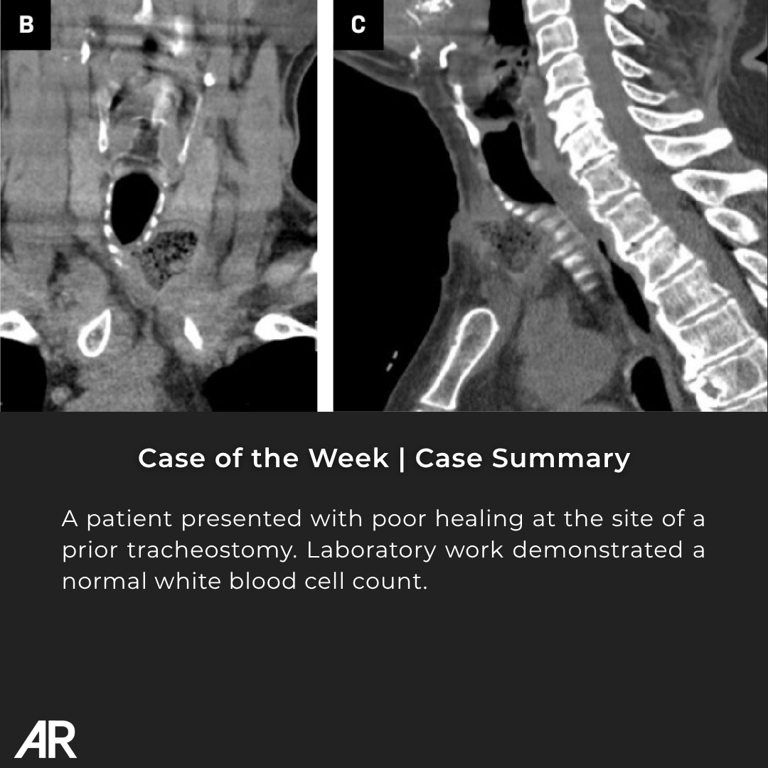 Applied_Rad's tweet photo. π©» Case Study of the Week!
A patient presented with poor healing at the site of a prior tracheostomy. Laboratory work demonstrated a normal white blood cell count.
π See all the case details, more images, and the diagnosis: https://t.co/o6EoOzIapF
#Radiology #RadEd #MedEd #RadiologyEducation #COW #CaseOfTheWeek