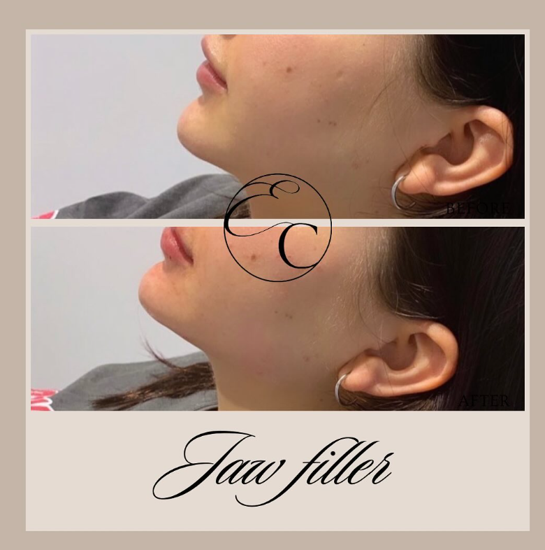 EnhanceClinicBe's tweet photo. 𝐉𝐚𝐰 𝐟𝐢𝐥𝐥𝐞𝐫💉

3ML filler in the jaw &amp; chin for this lovely lady.
Visit: https://t.co/kaVMRjnNu7
🕣 Appointment time: 20 min
🤕 Downtime: Bit of swelling and bruising can accur, allow two weeks to fully settle.

#enhanceclinic #aesthetic #ghent #botox #beauty #fillers https://t.co/8AodsAup1f