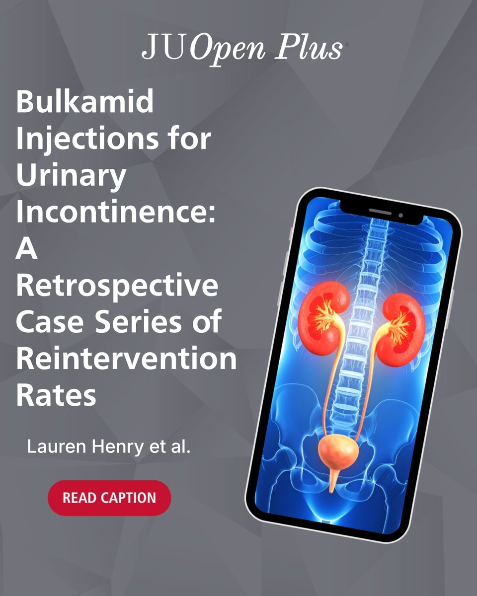 JUOpenPlus's tweet photo. 💉 Bulkamid Injections for Urinary Incontinence: What Do the Numbers Say?

A study reviews the reintervention rates of Bulkamid for SUI, highlighting its impact on symptom improvement.

📉 Reinterventions - 35.7% needed multiple injections
🔄 Symptom Relief - 65.2% reported better outcomes post-injection
💊 Comorbid Impact - Mixed incontinence improved more than pure SUI

#UrinaryIncontinence #Bulkamid #SUI https://t.co/YDsdDYeiyK