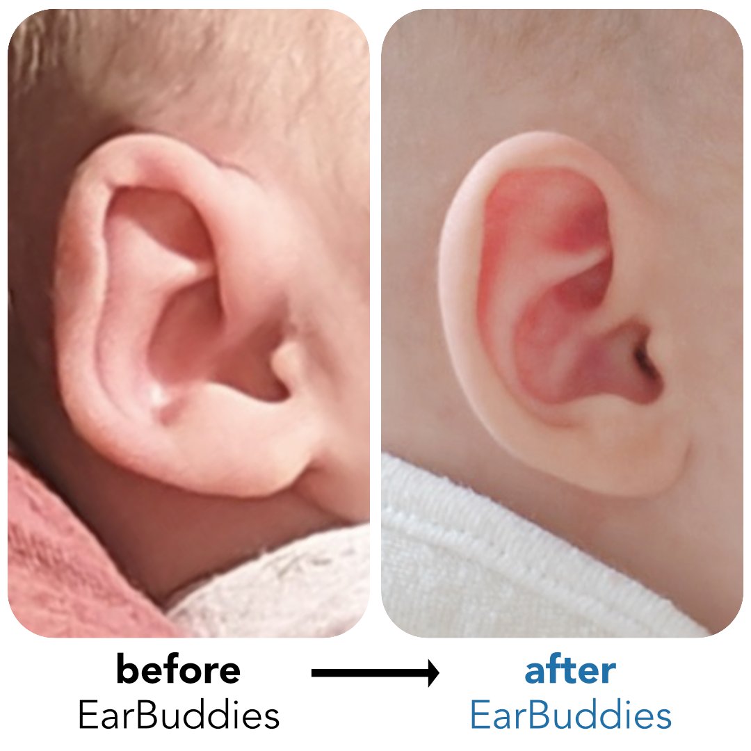 EarBuddies's tweet photo. “Thank you for creating such an effective product. We are so grateful for our daughter’s beautifully shaped ears.”
👂Read how Dora & hundreds of other parents used @EarBuddies to correct their babies' ears here: https://t.co/N44MhyLNSc
#foldoverhelicalrim #EarBuddies #EarSplint https://t.co/s0vlFuwyoF