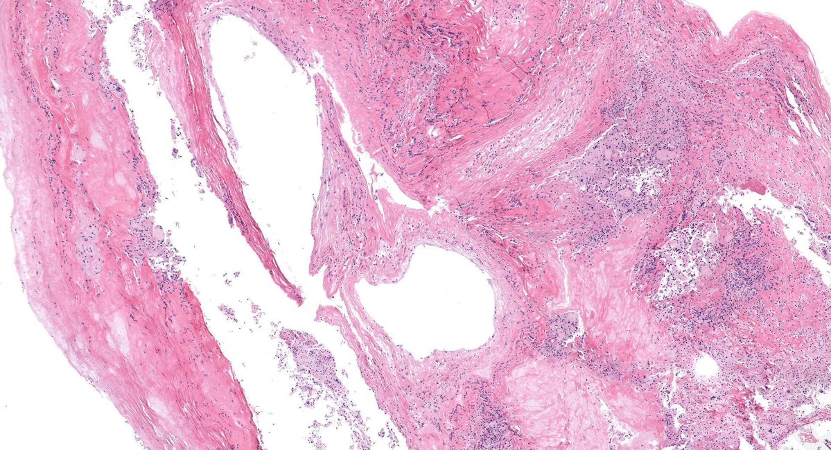 JMGardnerMD's tweet photo. 60 M. cystic bone lesion in proximal tibia. Tell me his medical history.
WSI digital slides: https://t.co/XbSxOzeOrq    
Answer: https://t.co/K7VJiPbf7f 
#BSTpath #pathologists #pathology #pathTwitter #orthotwitter #orthopedics https://t.co/UeFim9dyNN
