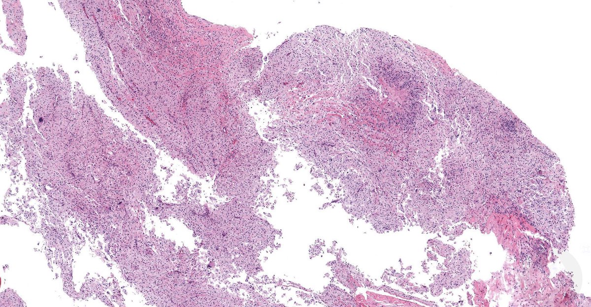 JMGardnerMD's tweet photo. 60 M. cystic bone lesion in proximal tibia. Tell me his medical history.
WSI digital slides: https://t.co/XbSxOzeOrq    
Answer: https://t.co/K7VJiPbf7f 
#BSTpath #pathologists #pathology #pathTwitter #orthotwitter #orthopedics https://t.co/UeFim9dyNN