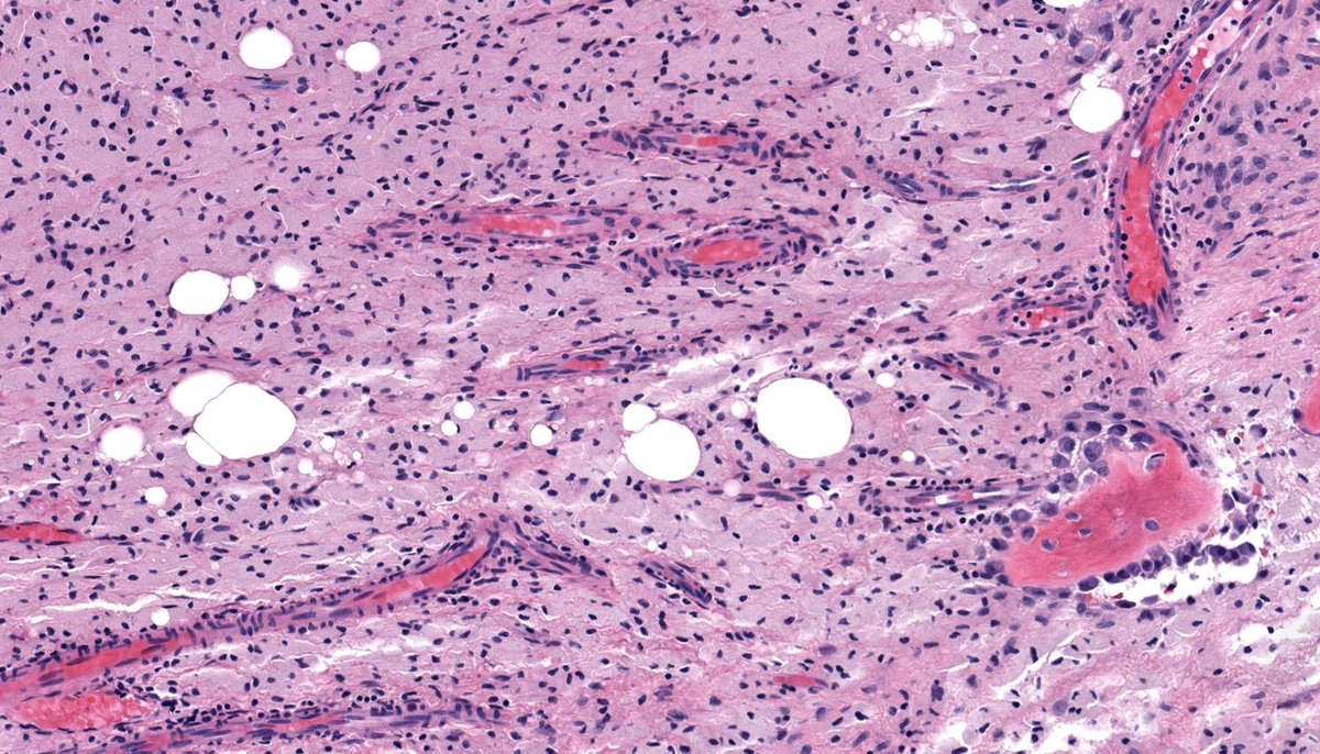 JMGardnerMD's tweet photo. 60 M. cystic bone lesion in proximal tibia. Tell me his medical history.
WSI digital slides: https://t.co/XbSxOzeOrq    
Answer: https://t.co/K7VJiPbf7f 
#BSTpath #pathologists #pathology #pathTwitter #orthotwitter #orthopedics https://t.co/UeFim9dyNN