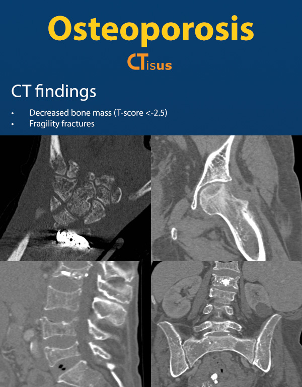 ctisus's tweet photo. Osteoporosis: CT Findings

https://t.co/EPSr3tsxHL https://t.co/9QfYskTj6F