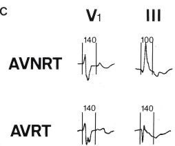 HiraaliCardio's tweet photo. Difference between AVNRT vs AVRT https://t.co/AKXqt4gqdc