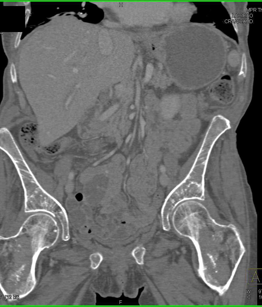 ctisus's tweet photo. Osteoporosis Involves the Lumbar Spine: https://t.co/cficHi2Mbz https://t.co/0JHya1nNvk