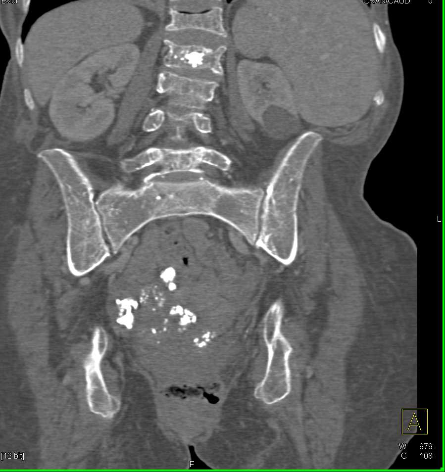 ctisus's tweet photo. Osteoporosis Involves the Lumbar Spine: https://t.co/cficHi2Mbz https://t.co/0JHya1nNvk