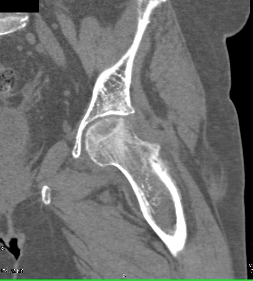 ctisus's tweet photo. Osteoporosis Left Femoral Head and Joint Effusion: https://t.co/WGccq2yin6 https://t.co/QkwLs9LmXJ