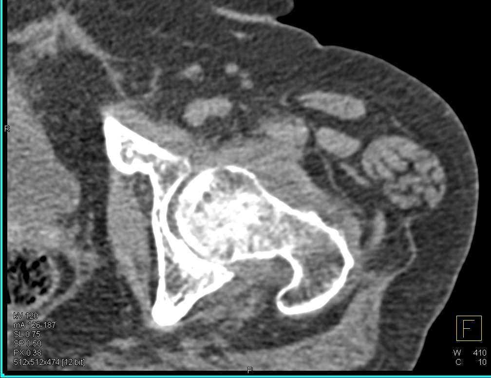 ctisus's tweet photo. Osteoporosis Left Femoral Head and Joint Effusion: https://t.co/WGccq2yin6 https://t.co/QkwLs9LmXJ